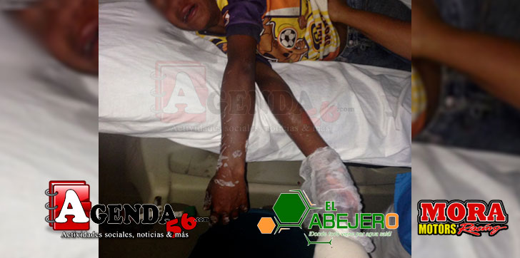 Mano-quemada-niño-Castillo