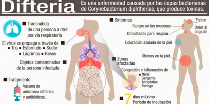 difteria