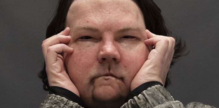 hombre-recibe-trasplante